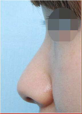 낮은코 전후사진