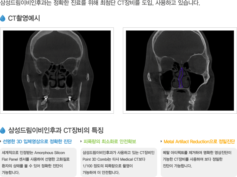 컴퓨터단층촬영