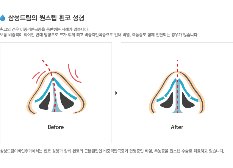 삼성드림의 원스텝 휜코 성형