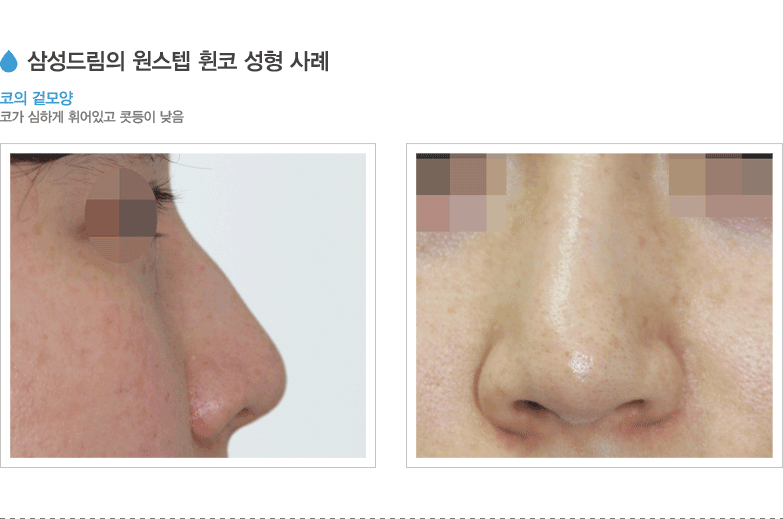 삼성드림의 원스텝 휜코 성형 사례