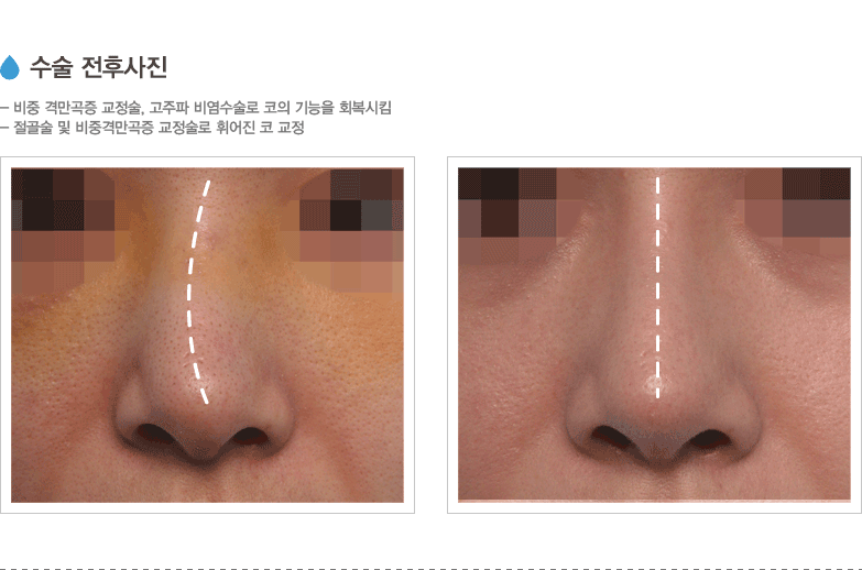 수술 전후사진