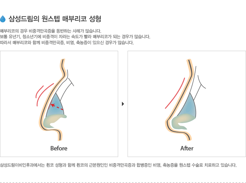 삼성드림의 원스텝 매부리코 성형