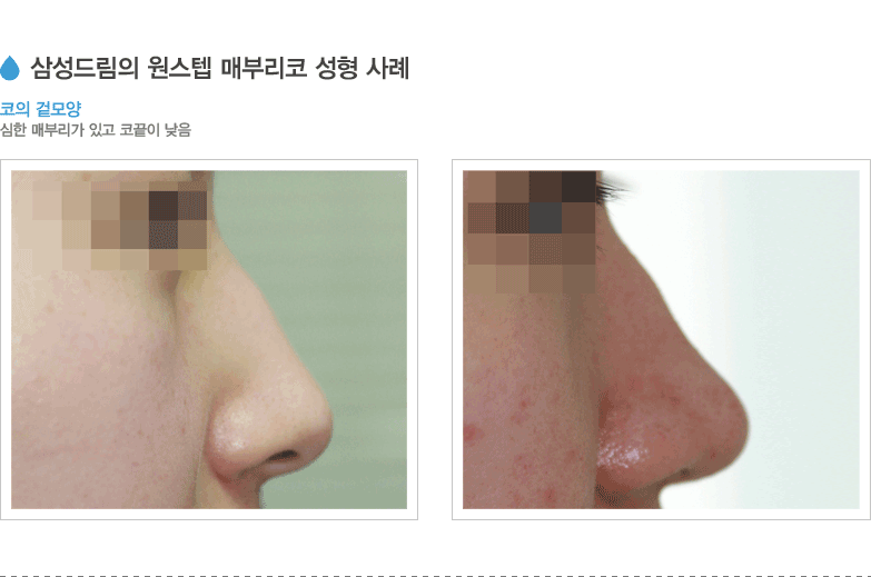 삼성드림의 원스텝 매부리코 성형 사례
