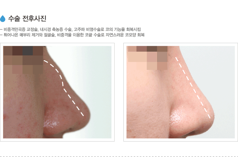수술 전후사진