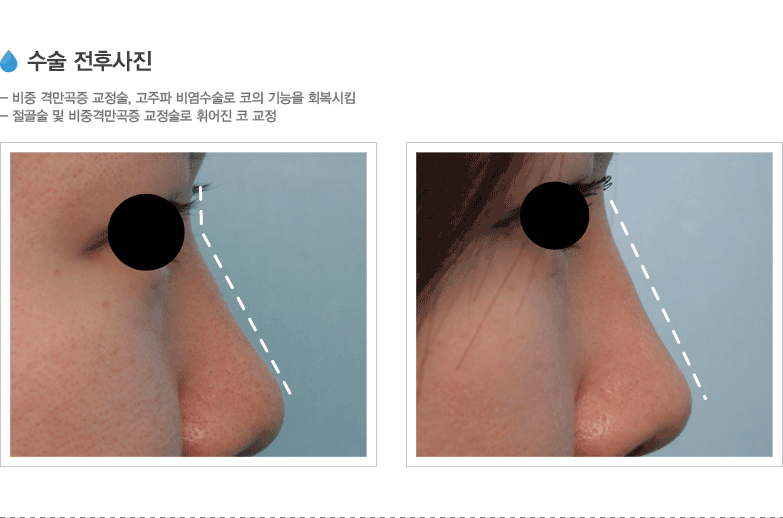 수술 전후사진