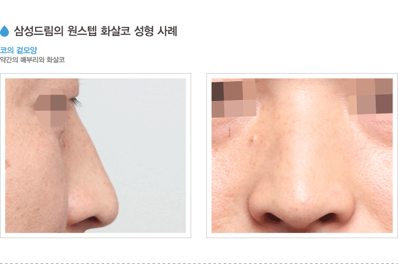 삼성드림의 원스텝 화살코 성형 사례