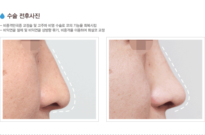 수술 전후사진