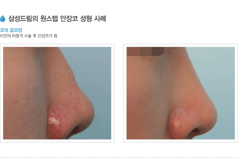 삼성드림의 원스텝 안장코 성형 사레