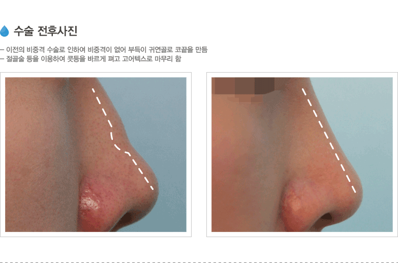 수술 전후사진