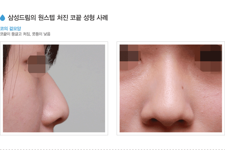 삼성드림의 원스텝 처진 코끝 성형 사례