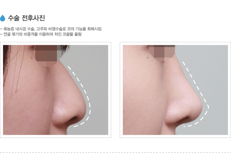 수술 전후사진