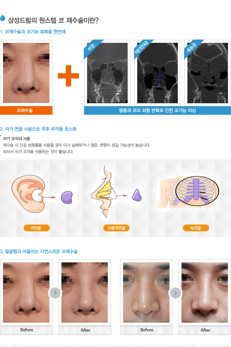 삼성드림의 원스텝 코 재수술이란?