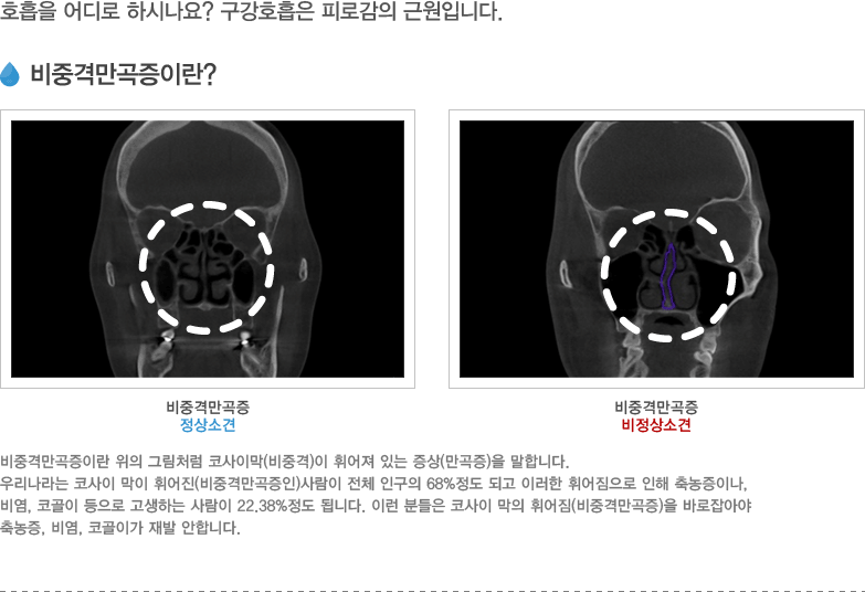 비중격만곡증이란?
