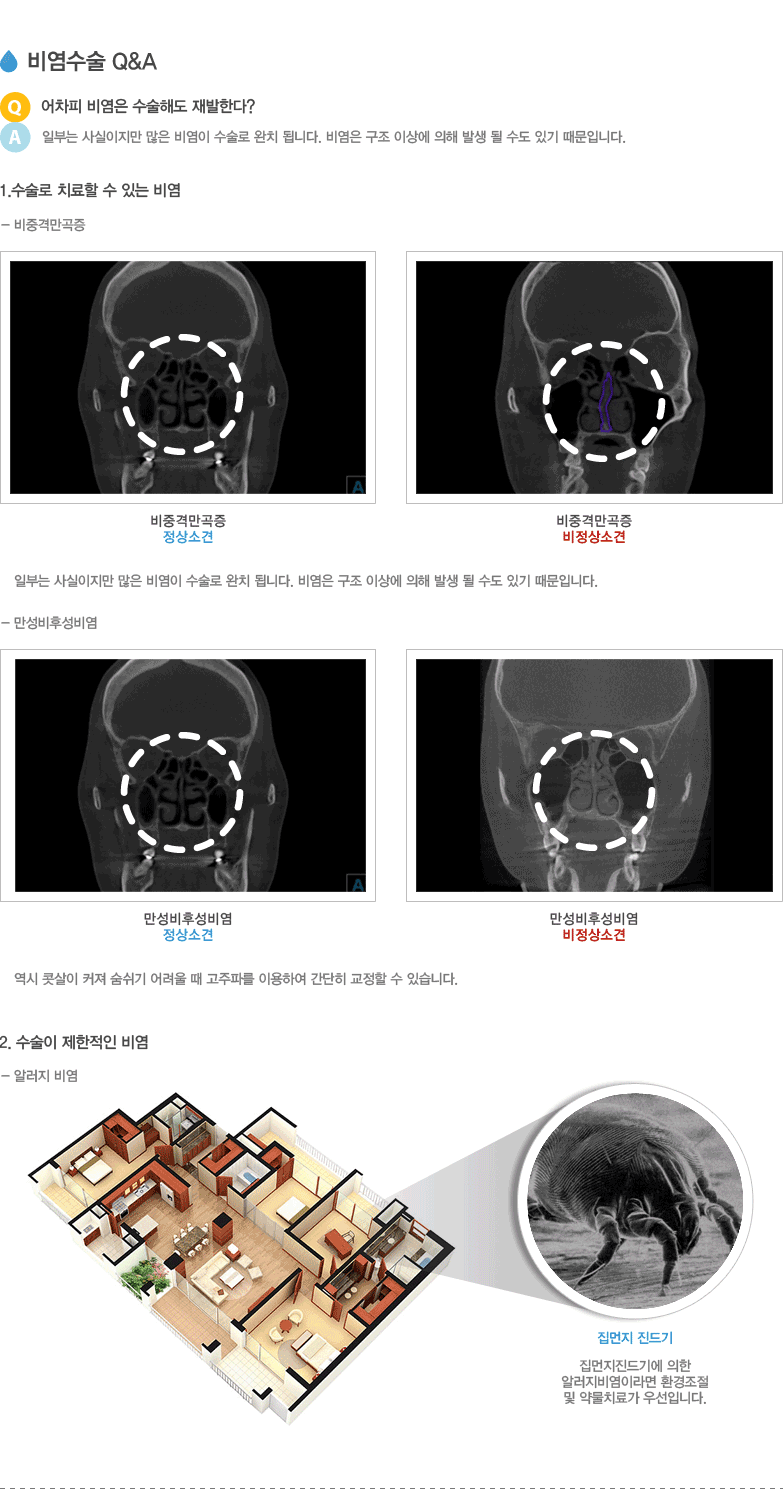 비염수술 Q&A