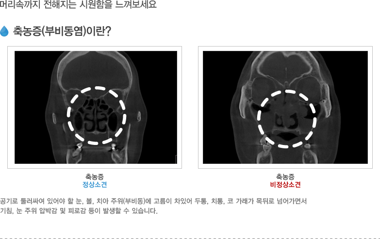 축농증(부비동염)이란?