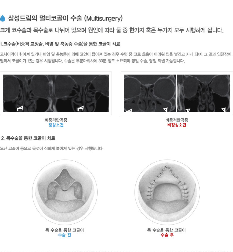 삼성드림의 멀티코골이 수술