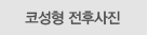 코성형 전후사진