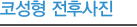 코성형 전후사진